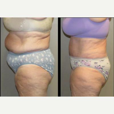 65-74 year old woman treated with Liposuction, Mini Tummy Tuck, Mommy Makeover, Tummy Tuck, Smart Lipo, Liposculpture, Body Lift - This is a 68-year-old who requested rejuvenation of her abdomen. She is seen here 4 months after liposuction of the upper/lower abdomen with removal of 6 pounds pure fat and removal of approximately 3 pounds of skin with an umbilical transposition. This is done with an oral sedation and local tumescent anesthesia as there is no need for deeper IV sedation.