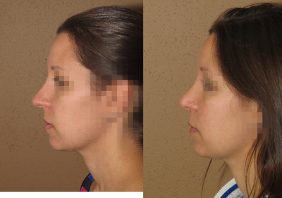 25-34 year old woman treated with Rhinoplasty - rhinoplasty