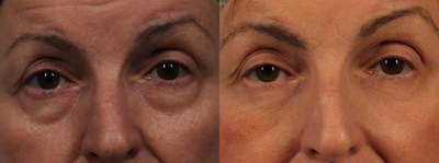 55-64 year old woman treated with Eyelid Surgery - Lower eyelid lift (transconjunctival) with fat grafting