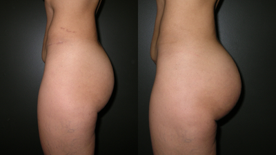 Buttock Augmentation with Implants - Patient is 5'2 and 123 pounds.
233cc Silicone Buttocks Implant in the Subfascial position.