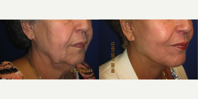 65-74 year old woman treated with Facelift combined with a neck lift - Almost 2 years after her facelift and neck lift, this patient still looks amazing and natural. Even though aging will continue, she will always look better than if she never had surgery.