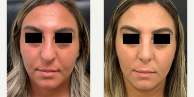 Woman treated with Rhinoplasty - Woman treated with Rhinoplasty