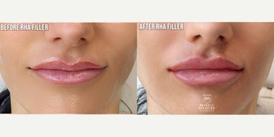 RHA Lip Filler for Natural Definition and Balance - This patient wanted subtle enhancement rather than dramatic volume. RHA filler was strategically placed to improve lip symmetry, refine the vermilion border, and create a smoother, more balanced contour while preserving natural movement and expression. Notice the enhanced definition of the Cupids bow, improved upper-to-lower lip proportion, and hydrated appearance without an overfilled look. Results shown immediately after treatment with mild expected swelling. Performed by a physician at Beverly Wilshire Aesthetics, Beverly Hills.