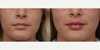 18-24 year old woman treated with Lip Fillers - This patient was concerned with the lack of volume in her lips. Her lips were injected with lip filler that helped her achieve her desired results.
