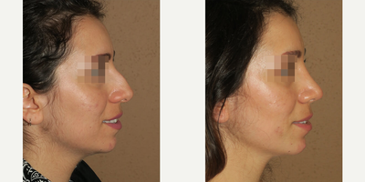 Woman treated with Rhinoplasty - Woman treated with Rhinoplasty