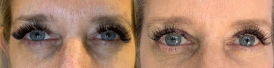55-64 year old woman treated with Eyelid Surgery - Patient had eyelids obstructing her vision. After an upper blepharoplasty and brow pexy, she is able to see clearly, and her eyes and face have opened up.