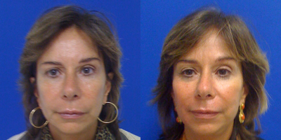 Case #Radiesse to Cheek Area - Radiesse for cheek augmentation. One of the best fillers for deeper fullness is Radiesse, and can be used for plumping up cheeks.