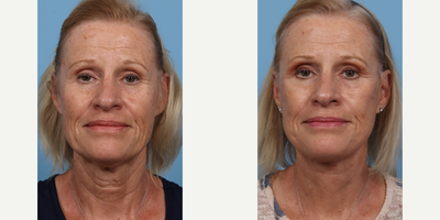 67 year old woman treated with Facelift - Facelift