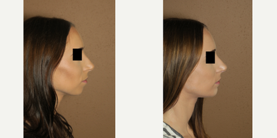 18-24 year old woman treated with Cheek Lift - silicone implant with no outside scars