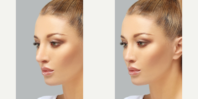 Woman treated with Rhinoplasty - Woman treated with Rhinoplasty