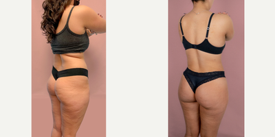 24 year old woman treated with Brazilian Butt Lift - This lovely patient is shown 2 months after brazilian butt lift. 750mL of fat was transferred into each buttock/hip dip.