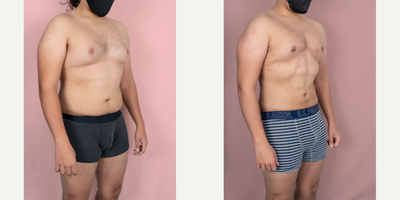 18-24 year old man treated with Abdominal Etching - This young patient is shown 2 months after an abdominal high definition liposuction.