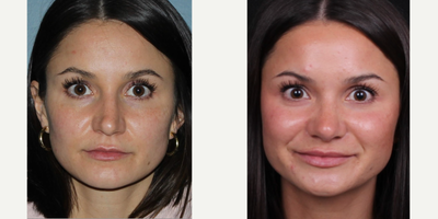 25-34 year old woman treated with Rhinoplasty - Rhinoplasty B&A