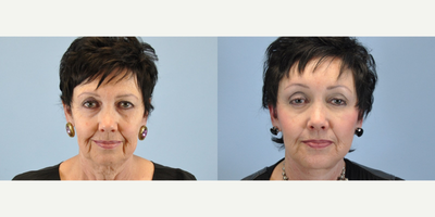 65-74 year old woman treated with Neck Lift - This woman decided to have a Necklift.