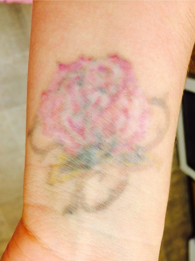 Tattoo Laser Removal - Wrist - PicoSure review - RealSelf