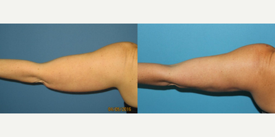 Woman treated with Smart Lipo - Liposuction - Arms / Axillary