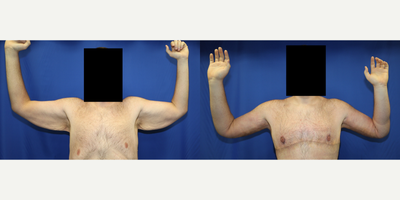 25-34 year old man treated with Arm Lift - This is a 27 year old White patient who is 64 and weighed over 500 pounds.He lost over 270 pounds through diet and exercise. He was not happy with the excess skin and fat in his arms.He traveled from Florida to California to have an arm lift, aka brachioplasty with Dr. J. Timothy Katzen. He also had a horizontal torsoplasty and gynecomastia surgery at the same time. He is very happy with the results of the surgeries.