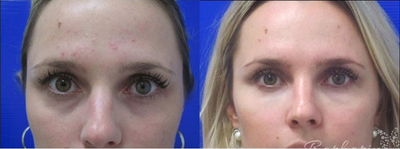 Woman treated with Radiesse - Woman treated with Radiesse