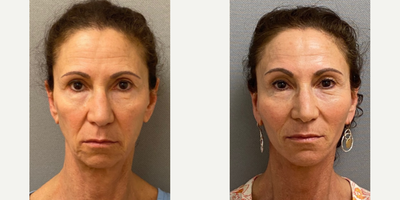 60 year old woman treated with Facelift, Neck Lift, and SMAS Facelift - 60 year old woman treated with Facelift, Neck Lift, and SMAS Facelift