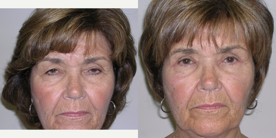 65-74 year old woman treated with Eyelid Surgery - 68 year old female shown before and three weeks after an upper eyelid blepharoplasty. The patient had excess skin covering the eyelid and her vision was impaired. The procedure was done at the surgical center and took one hour. The patient went home the same day. Complete healing can be completed in 6 weeks. The excess skin was removed from the upper eyelids. All procedures done by Frank J. Ferraro, MD FACS.