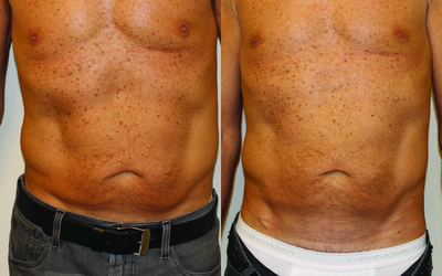 Venus Legacy - Before and After 2 Treatments.  Photos provided courtesy of Venus Concept.