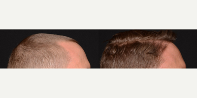 Woman treated with NeoGraft, Hair Transplant - Dont let hair loss get you down!Here at Beyond Beautiful, we offer the NeoGraft Hair Transplantation System to men and women who suffer from male/female pattern baldness or thinning hair. We believe that hair restoration doesnt just give back the hair that was lost, it can also help to reestablish ones self-confidence to help you not only look better but FEEL better!