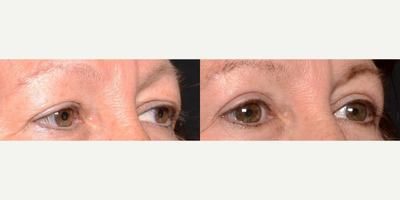 Woman treated with Eyelid Surgery - First appearances are EVERYTHING, and your eyes are what people notice first. Are you tired of looking tired? Want younger-looking eyes? The solution may be an upper eyelid surgery by Dr.Ho. One of the first signs of aging are the droopy eyelids. Let Dr.Ho, a double board certified plastic surgeon, perform a relatively quick and easy surgery to correct loose hanging skin above your eyes to refresh your look. This procedure is performed on an outpatient basis with little or no downtime!