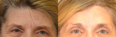 45-54 year old woman treated with Brow Lift - patient with brow ptosis and forehead wrinkles