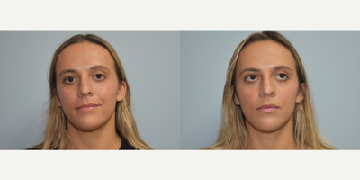 25-34 year old woman treated with Lip Augmentation - 26 year old female with Juvaderm Ultra to lips for improved volume and symmetry. After photo is 2 weeks following treatment.