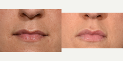 25-34 year old woman treated with Lip Augmentation - 27 year old female treated with Juvederm volbella to the lips to improve lip volume and symmetry.