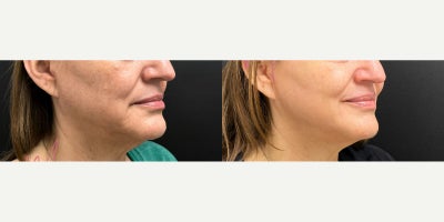 35-44 year old woman treated with Facial, IPL, Chemical Peel - Series of 3 with Alyssa G.