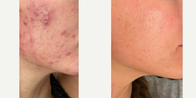 25-34 year old woman treated with Facial, Chemical Peel - Series of 3 with Alyssa G.