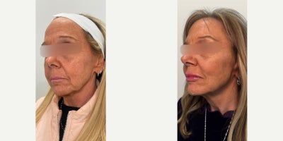 55-64 year old woman treated with Sculptra, Lip Fillers - 55-64 year old woman treated with Sculptra, Lip Fillers