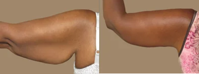 Arm lift - post weight loss - Arm lift -usually performed for a massive weight loss patients after gastric bypass or gastric banding but also in other conditons