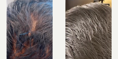 Man treated with PRP for Hair Loss, Hair Loss Treatment - 24k Gold Hair Treatment - an exclusive specialized PRP treatment with results after your first treatment.No surgery.No downtime.Just results.