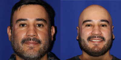 35-44 year old man treated with Ear Surgery - Wanted otoplasty