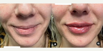 Woman treated with Dermal Fillers - Did you know injectable fillers with hyaluronic acid can help your lips stay hydrated?