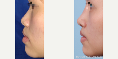 25-34 year old woman treated with Asian Rhinoplasty - Asian Rhinoplasty with EPTFE Implant