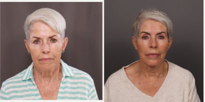 75 and up year old woman treated with Facelift, Double Eyelid Surgery, Facial Fat Transfer, Botox, Dermal Fillers, Laser Resurfa - Facelift, Upper & Lower Blepharoplasty, Fat Grafting by Dr. Thompson. Contour TRL, Botox, Dermal Fillers, and Hydrafacial. 3 years post-operative.