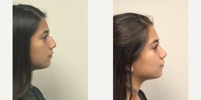 17 or under year old woman treated with Rhinoplasty - 15 year ole female shown before and 5 weeks after an open rhinoplasty to reduce the dorsum (top) of her nose and elevate her tip. All procedure done by Frank J. Ferraro, MD 