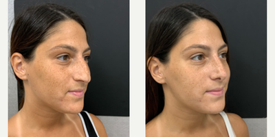 Woman treated with Rhinoplasty - Rhinoplasty