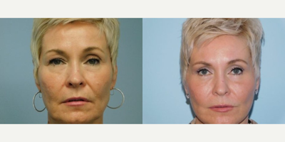 Woman treated with Facelift - Before and 1 month after Traditional Facelift, Lower Lid Blepharoplasty and Right Upper Lid Blepharoplasty.