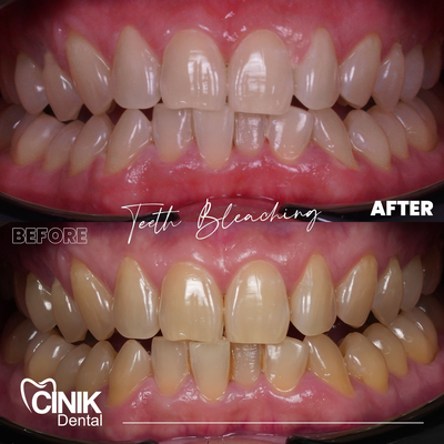 25-34 year old man treated with Teeth Whitening - Teeth Whitening