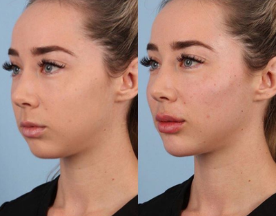 Woman treated with Nonsurgical Facelift - Woman treated with Nonsurgical Facelift