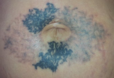 Painful but Worth It -Fort Collins, CO - Tattoo Removal 