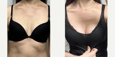 18-24 year old woman treated with Breast Augmentation, Breast Implants - Breast augmentation performed to restore volume and improve upper pole fullness with a natural, proportionate result.