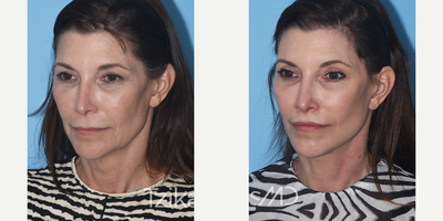 55-64 year old woman treated with Facelift - Deep Plane Facelift, Temporal Brow Lift, Upper Blepharoplasty, Lip Lift, Platysmaplasty & eCO2 laser of lower eyelid skin.
