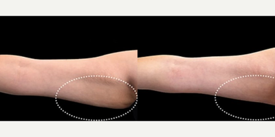 Woman treated with Emsculpt - Woman treated with Emsculpt