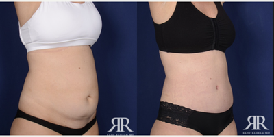 35-44 year old woman treated with Tummy Tuck - Tummy Tuck