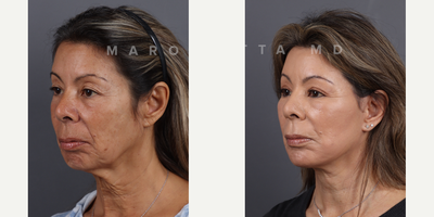 Woman treated with Eyelid Surgery - Facial rejuvenation with Dr James Marotta. Before and after journey. Dr. Marotta's expertise shines through in these great results, achieved through a combination of deep plane face and neck lift, upper blepharoplasty, perioral dermabrasion, and a chemical peel. Deep Plane Face and Neck Lift: Elevate your beauty to new heights as Dr. Marotta reshapes and rejuvenates facial contours by addressing deeper layers, tackling sagging skin and restoring youthful volume. Upper Blepharoplasty: Open your eyes to a brighter, more refreshed look! Dr. Marotta's precise upper blepharoplasty technique removes excess skin, revealing the true beauty of your gaze. Perioral Dermabrasion: Erase the traces of time around your mouth with perioral dermabrasion. Experience smoother, radiant skin as fine lines and wrinkles fade away. Chemical Peel Magic: Peel back the years with a chemical peel curated by Dr. Marotta. Unveil a radiant complexion, free from imperfections, as the outer layers of your skin are renewed.